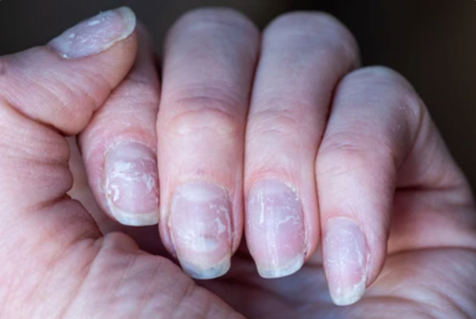 Waarom je broze nagels hebt en wat je eraan kunt doen